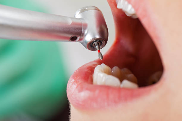 Best Emergency Dentist for Lost Fillings or Crowns in Bourbonnais, IL